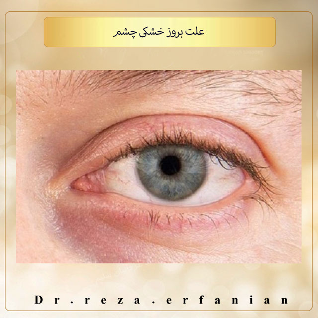علت بروز خشکی چشم
