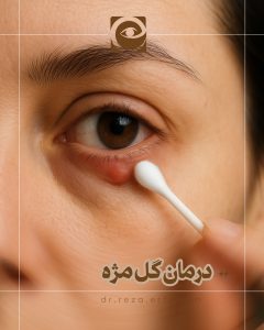 درمان گل مژه