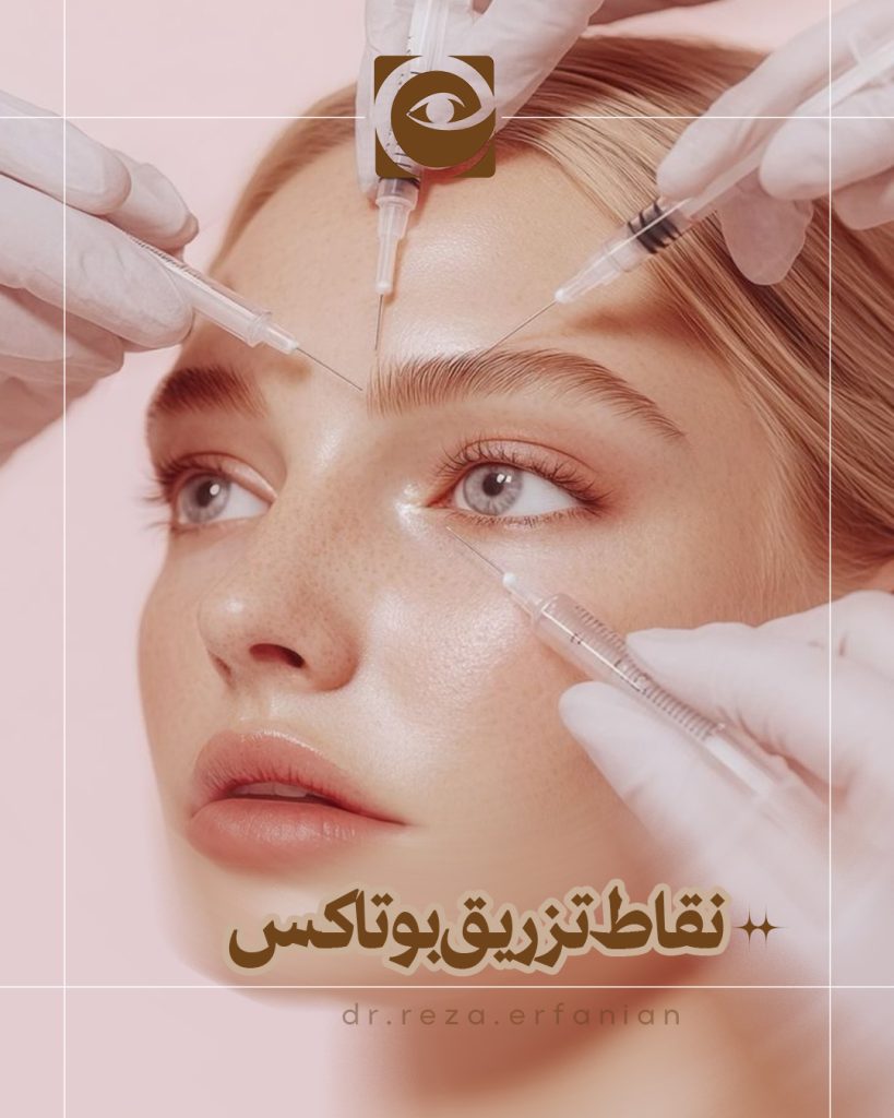 نقاط تزریق بوتاکس