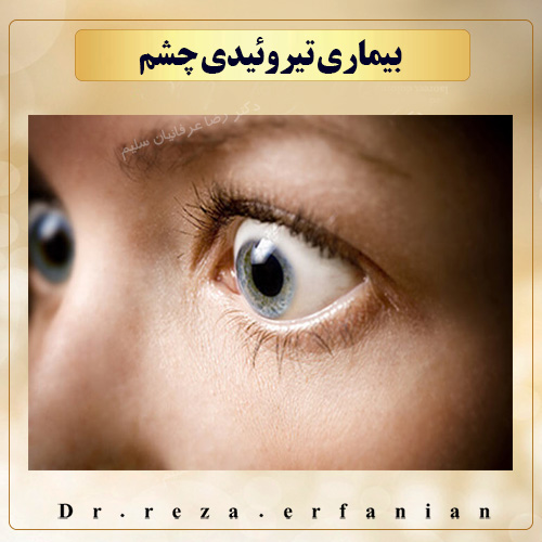 بیماری تیروئیدی چشم