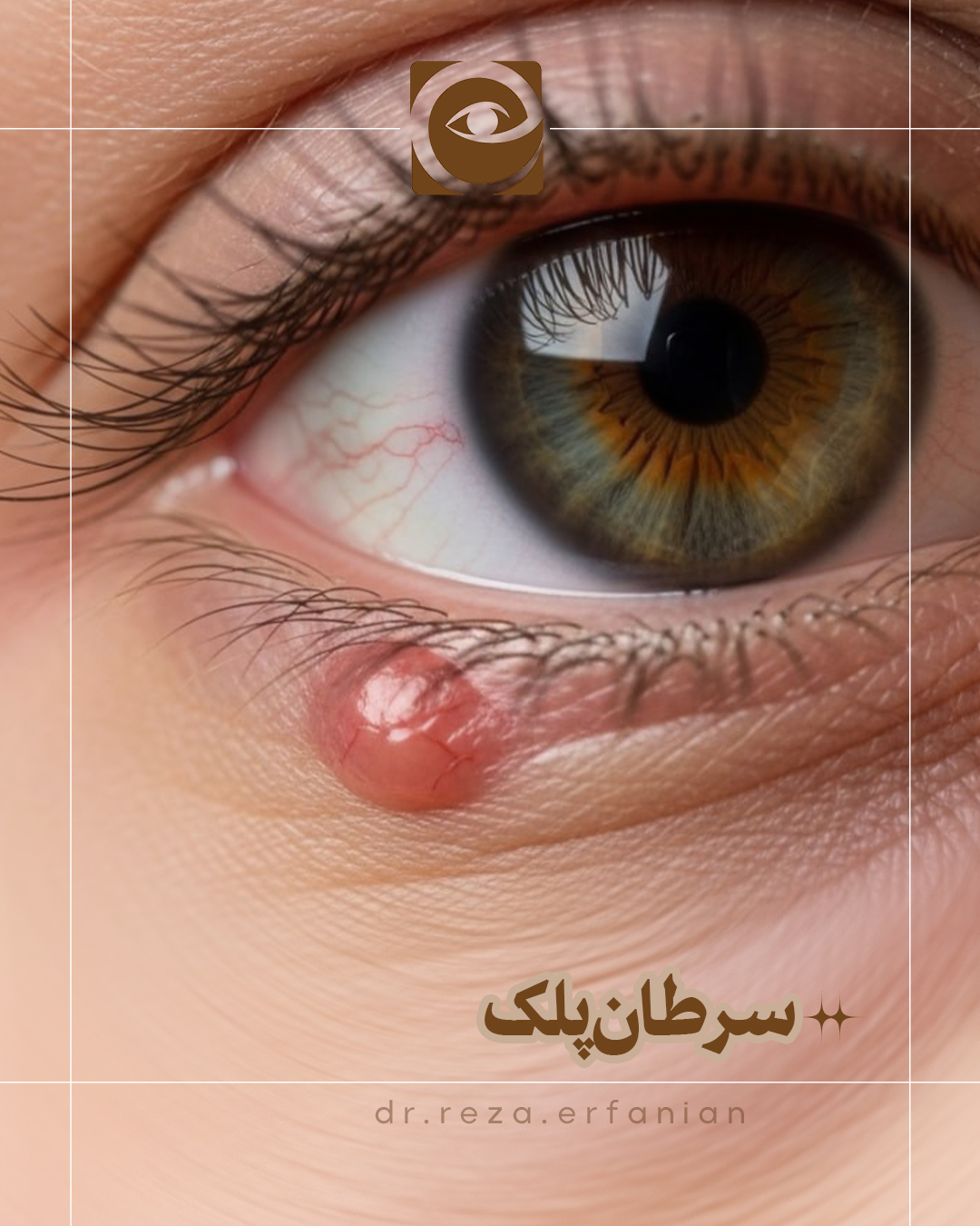 سرطان پلک