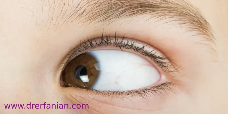 انحراف عمودی ( انحراف به بالا و انحراف به پایین)