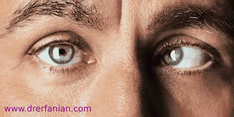 انواع انحراف چشم کدامند؟