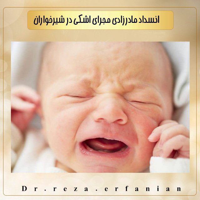 انسداد مادرزادی مجرای اشکی در شیرخواران