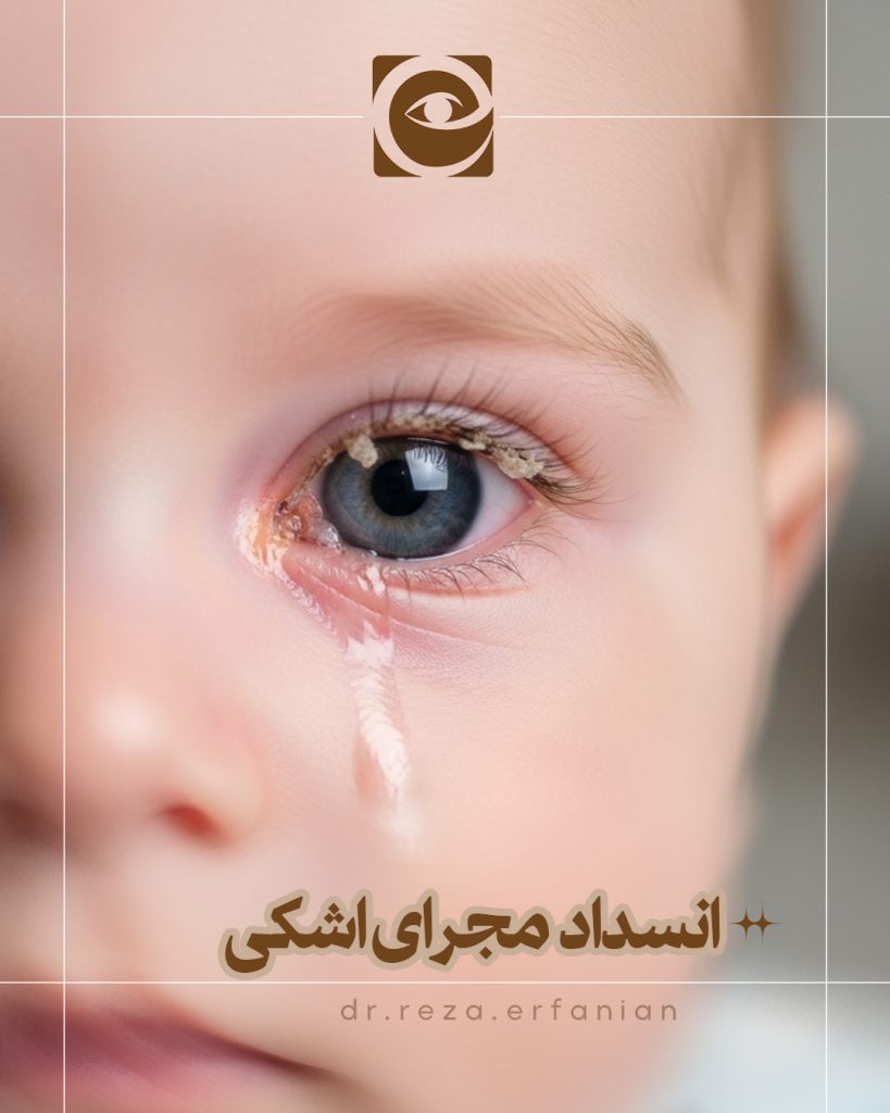 انسداد مادرزادی مجرای اشکی در شیرخواران