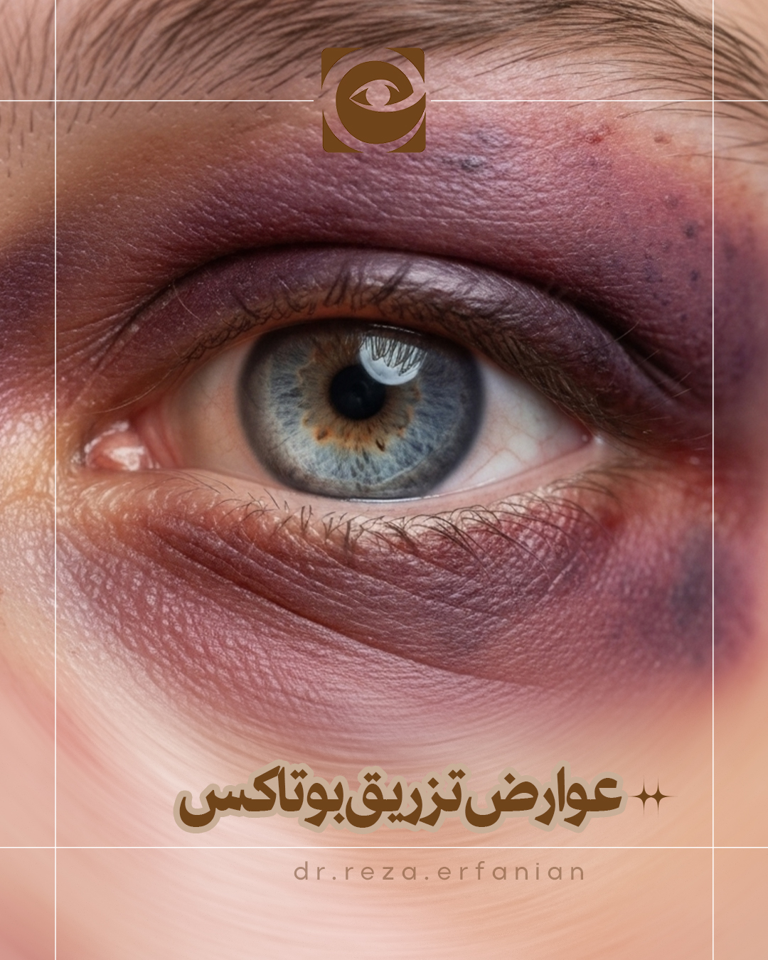 عوارض تزریق بوتاکس توسط غیر متخصص