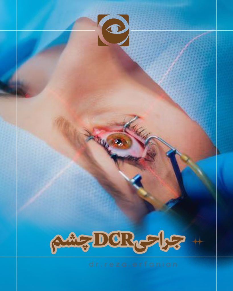 جراحی DCR چشم