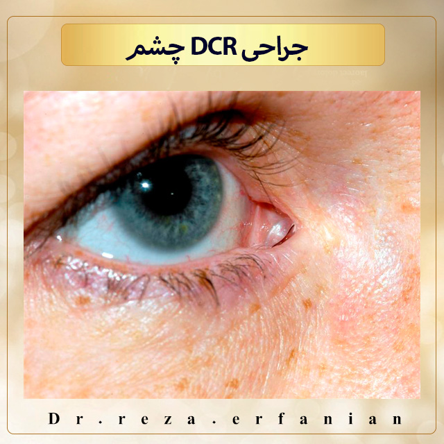 جراحی DCR چشم