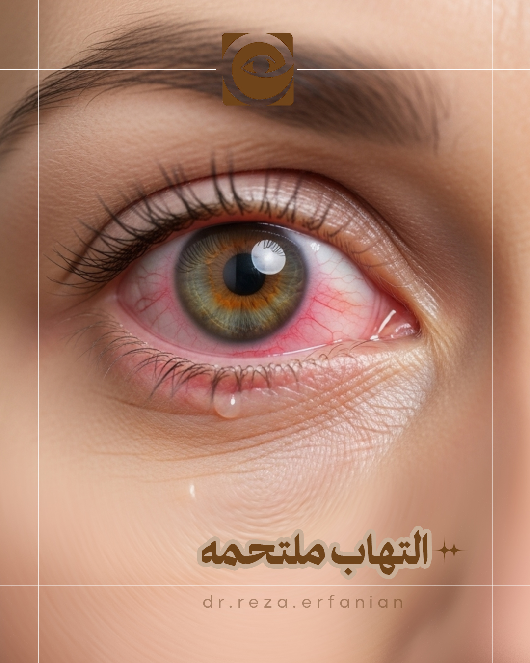 تراخم یا التهاب ملتحمه