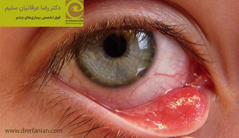 علل بروز شالازیون چشم