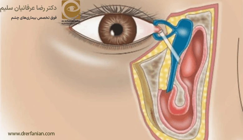 تشخیص انسداد مجرای اشکی