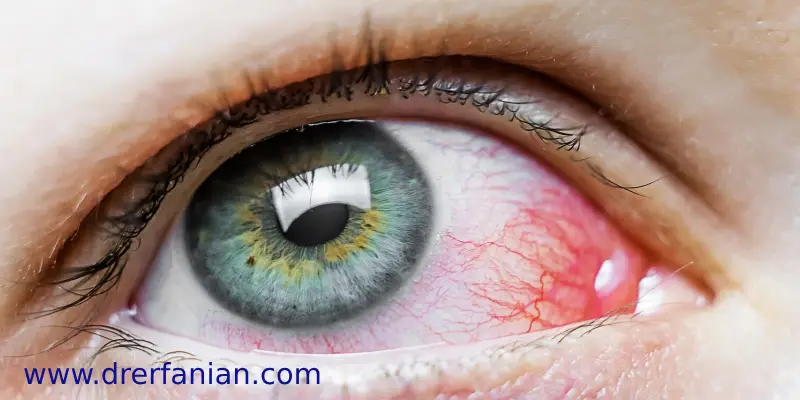 علائم زخم قرنیه