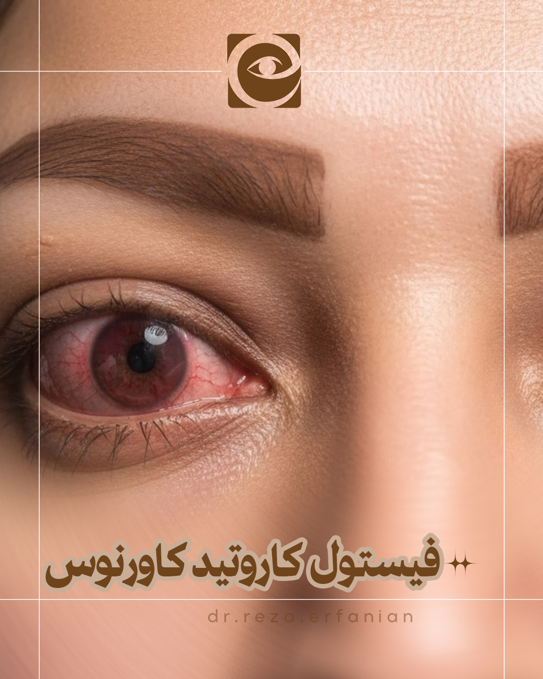 بیماری فیستول کاروتید کاورنوس