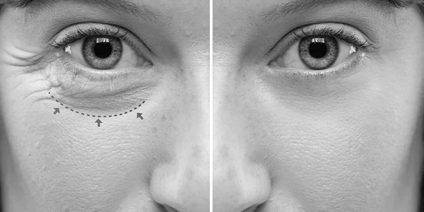 از بین بردن ورم بعد از عمل پلک