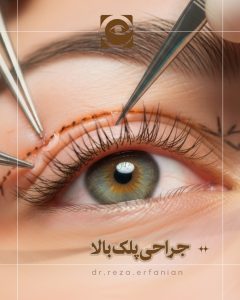 جراحی پلک بالا
