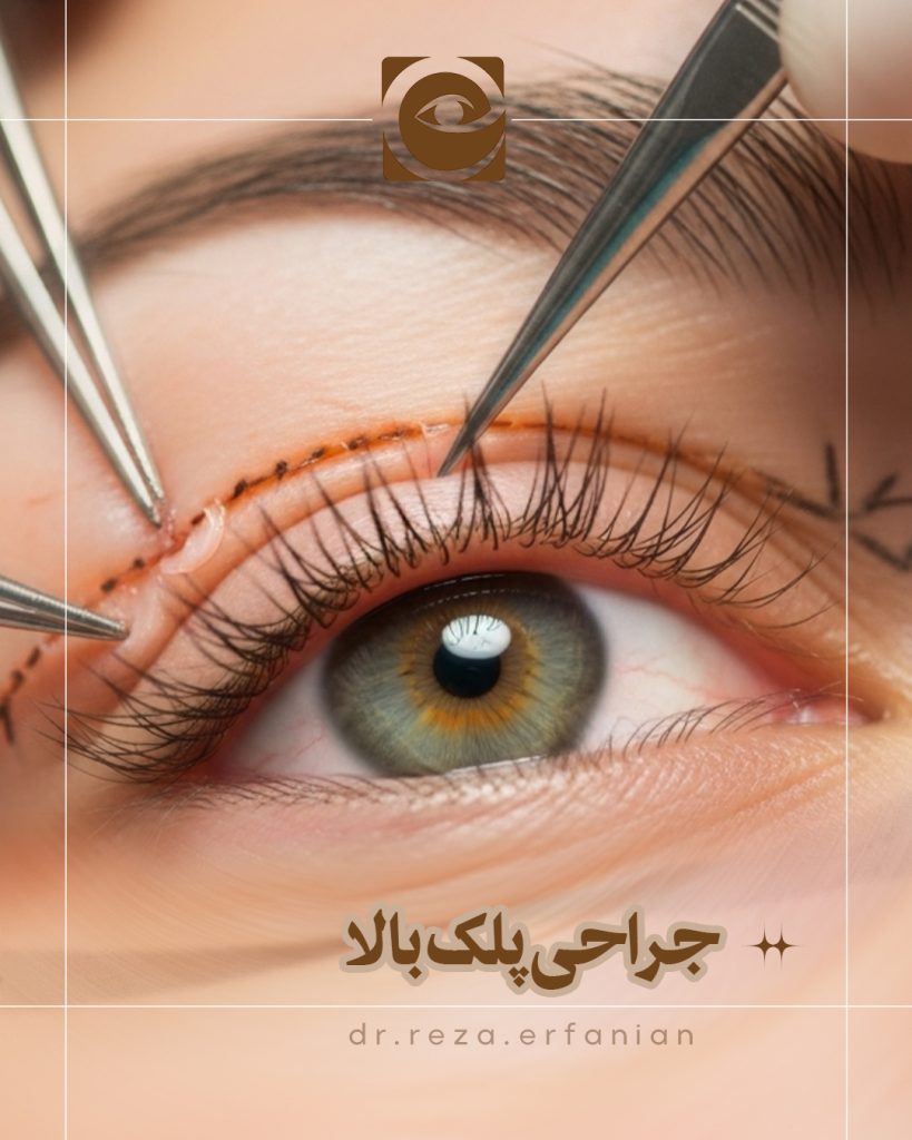 جراحی پلک بالا