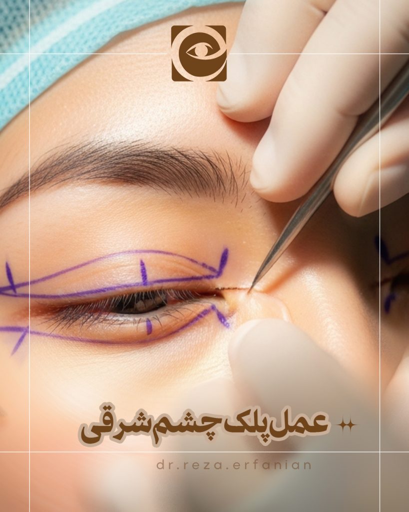 عمل پلک چشم شرقی