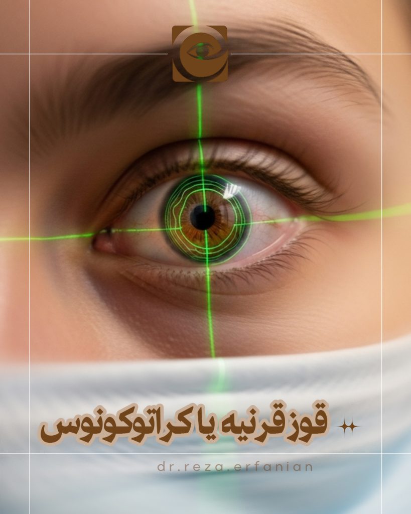 قوز قرنیه یا کراتوکونوس