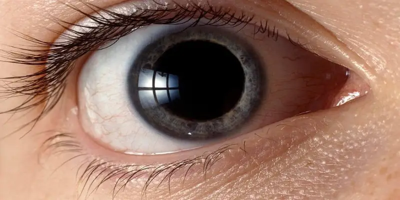 بهترین سن برای عمل انحراف چشم چه سنی است؟