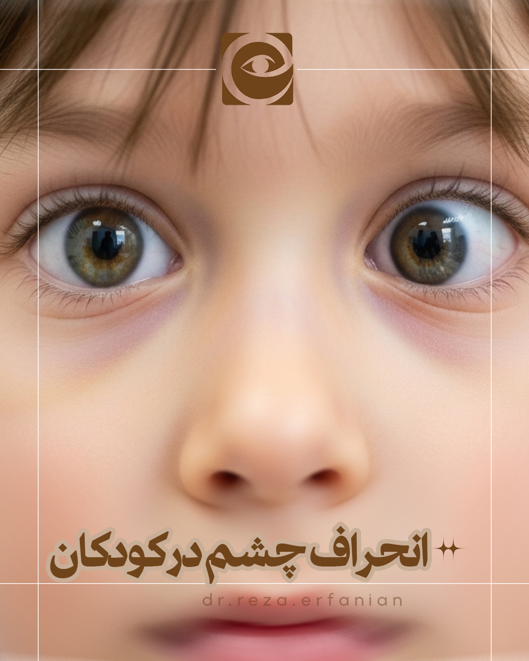 انحراف چشم در کودکان