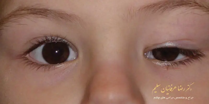 افتادگی پلک در کودکان