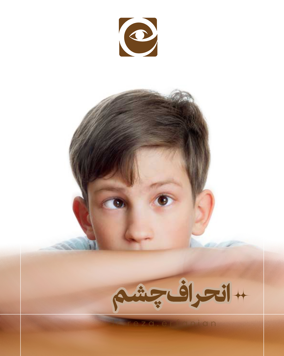 انواع انحراف چشم