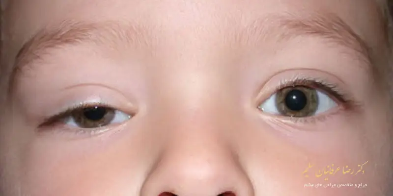 انواع پتوز یا افتادگی پلک در کودکان