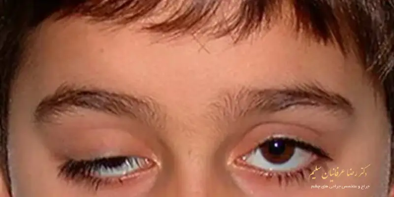 درمان افتادگی پلک در کودکان