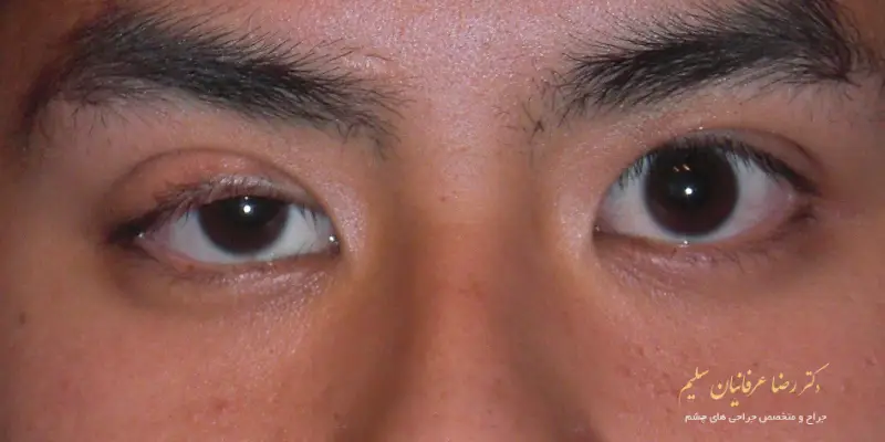 روش_های درمان افتادگی پلک در کودکان