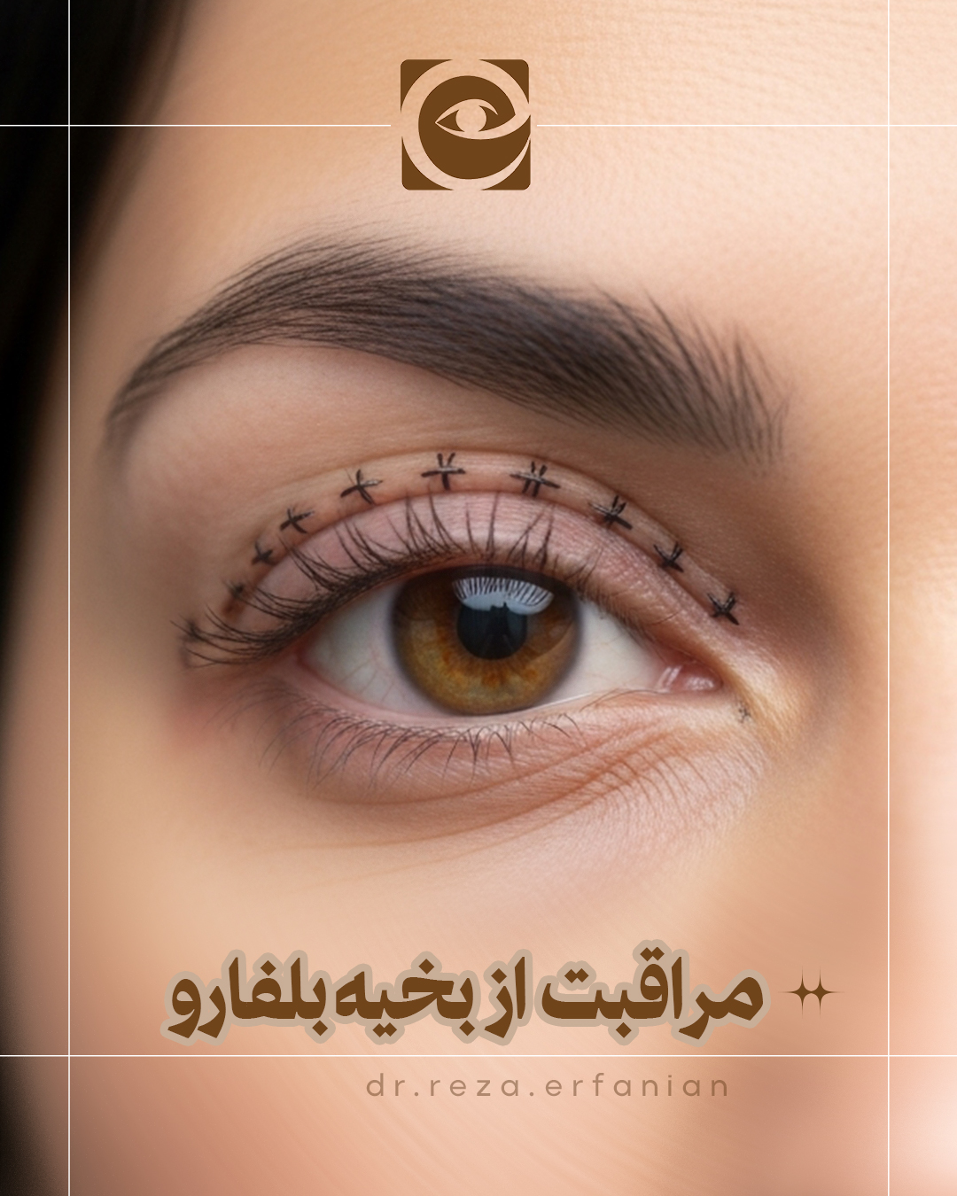 مراقبت از بخیه بلفاروپلاستی