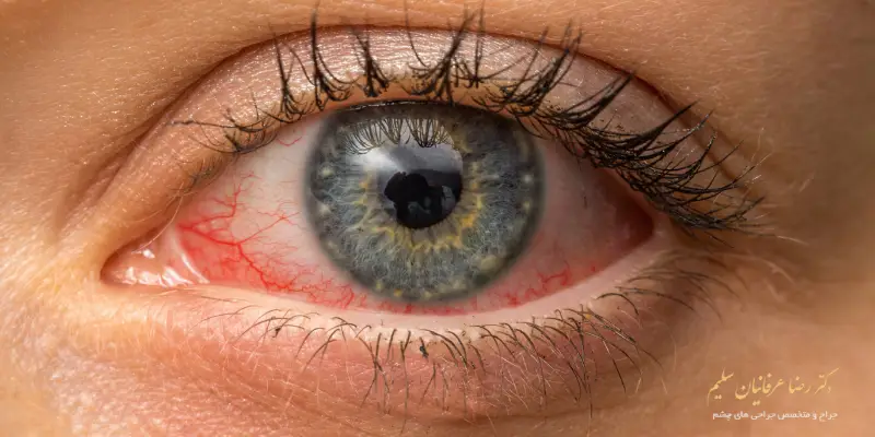 14 علت عفونت چشم