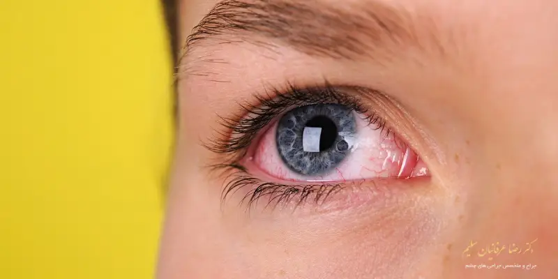 انواع عفونت چشم