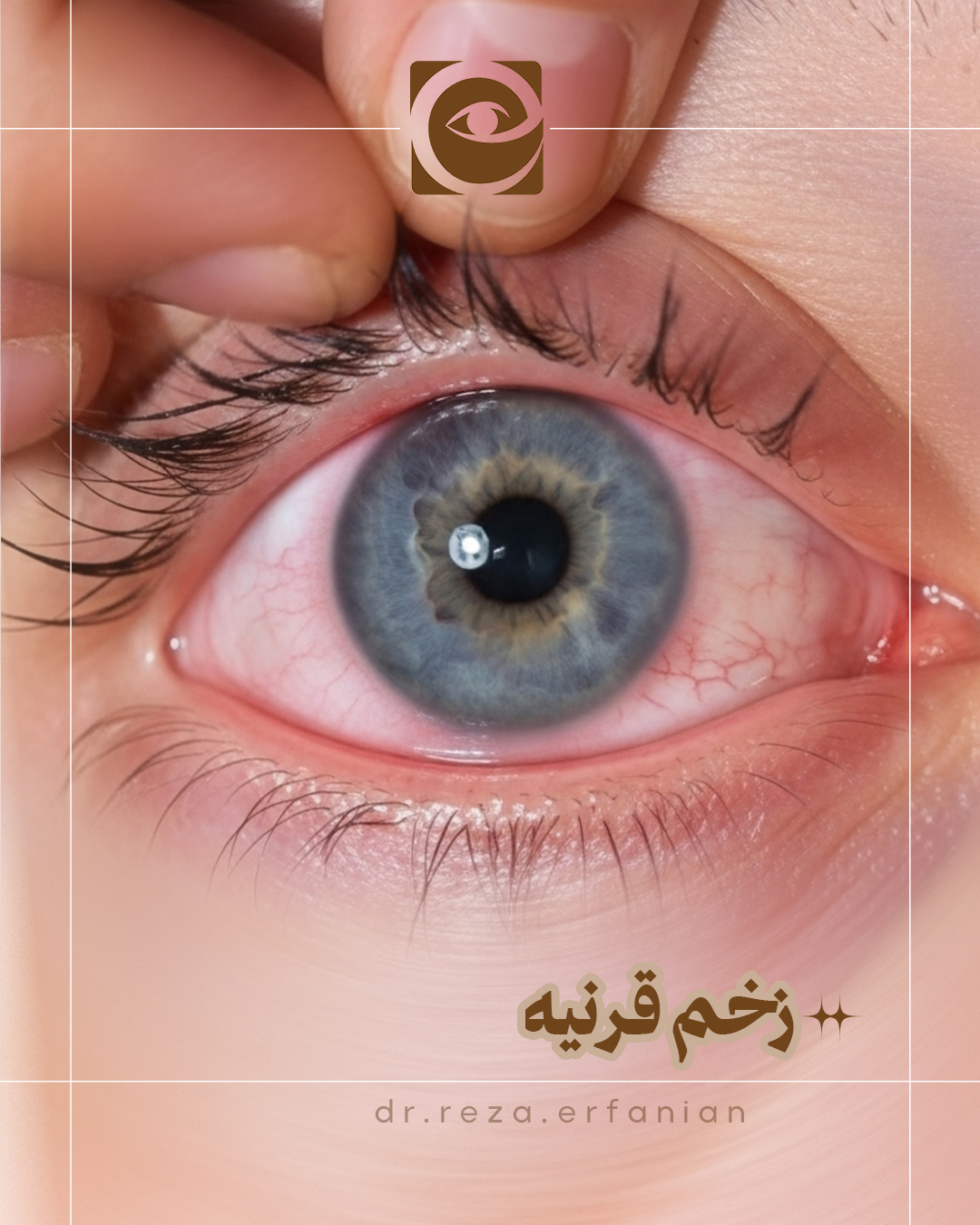 زخم قرنیه