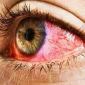 عفونت چشم، علت، علائم و انواع