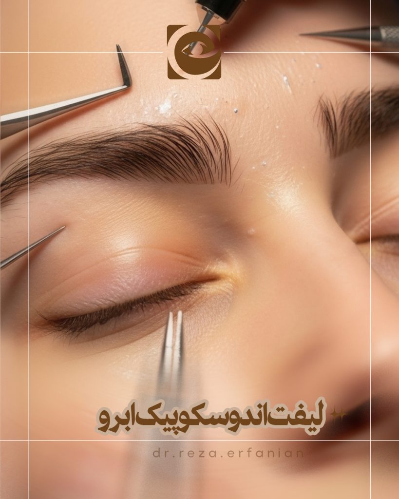 لیفت اندوسکوپیک ابرو