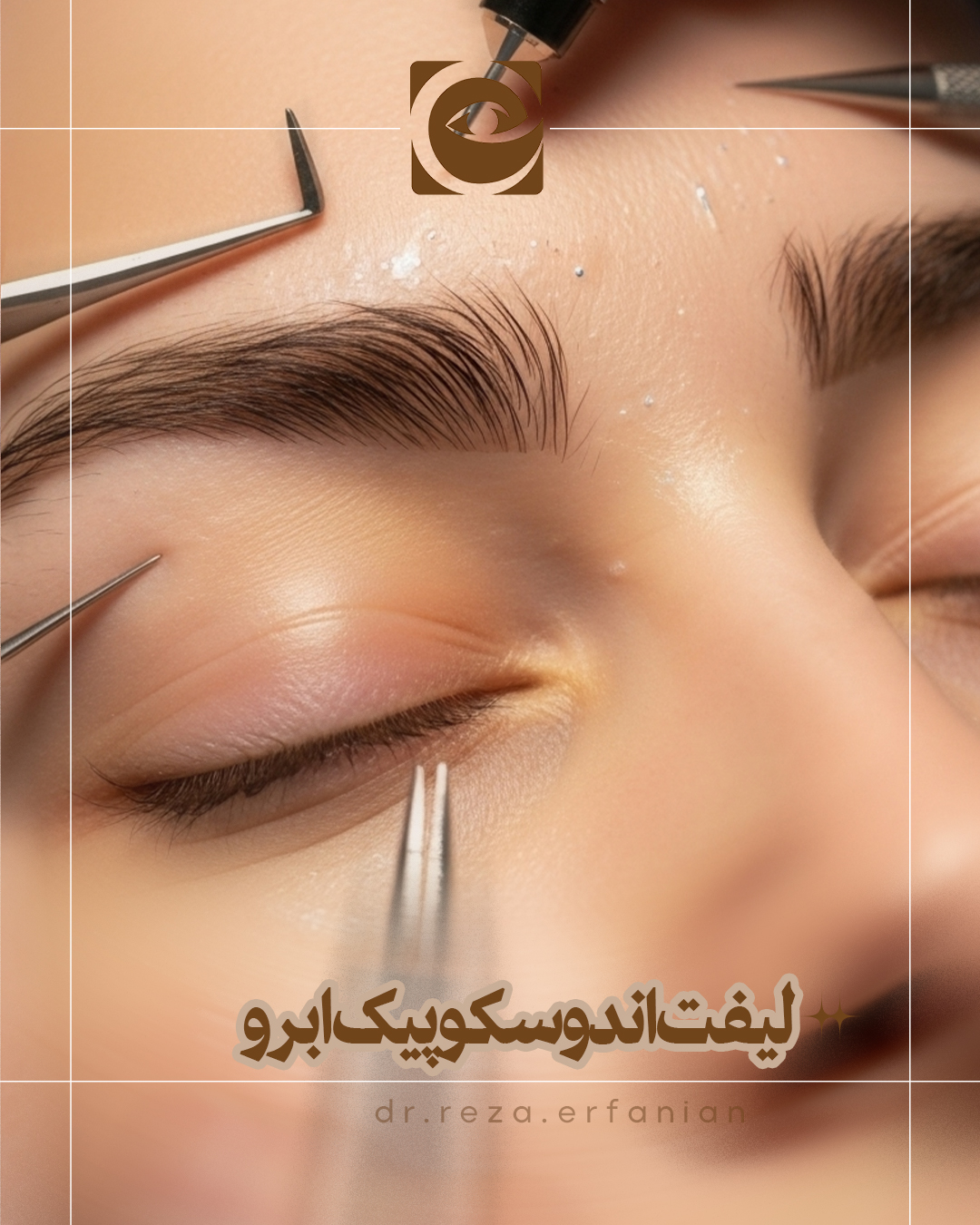 لیفت اندوسکوپیک ابرو