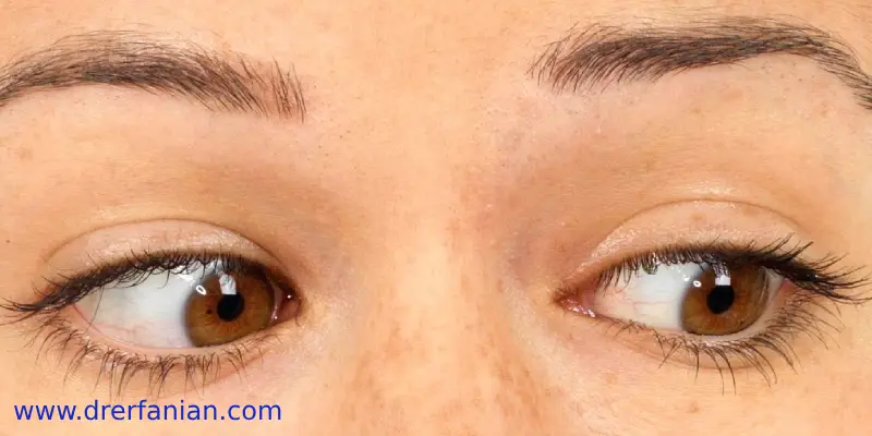 انحراف چشم در بزرگسالان انحراف چشم در بزرگسالان