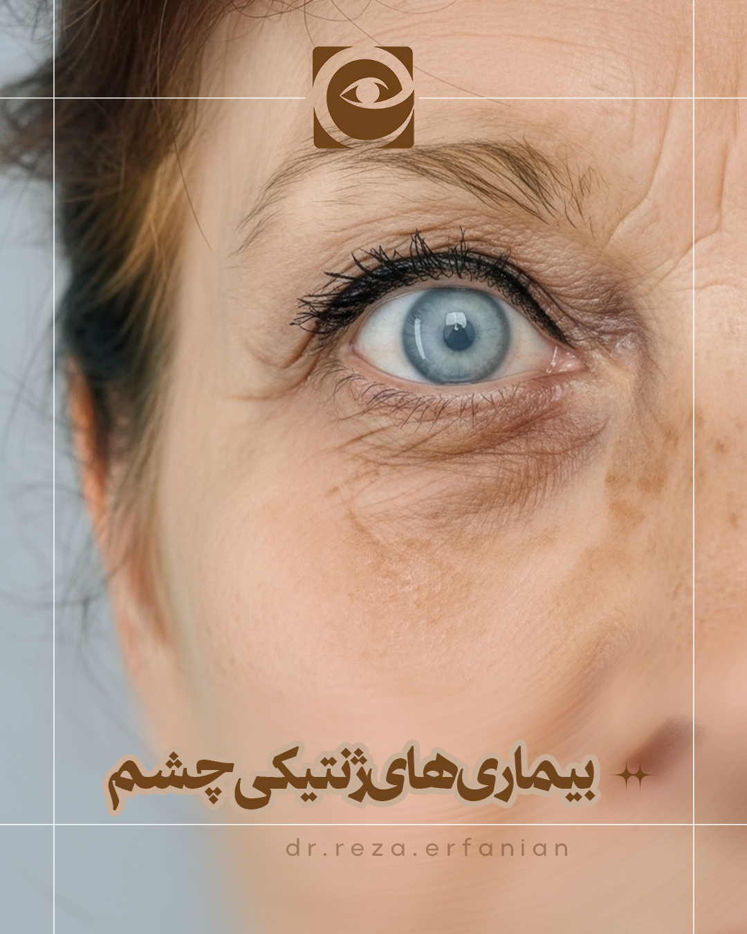 بیماری‌های ژنتیکی چشم