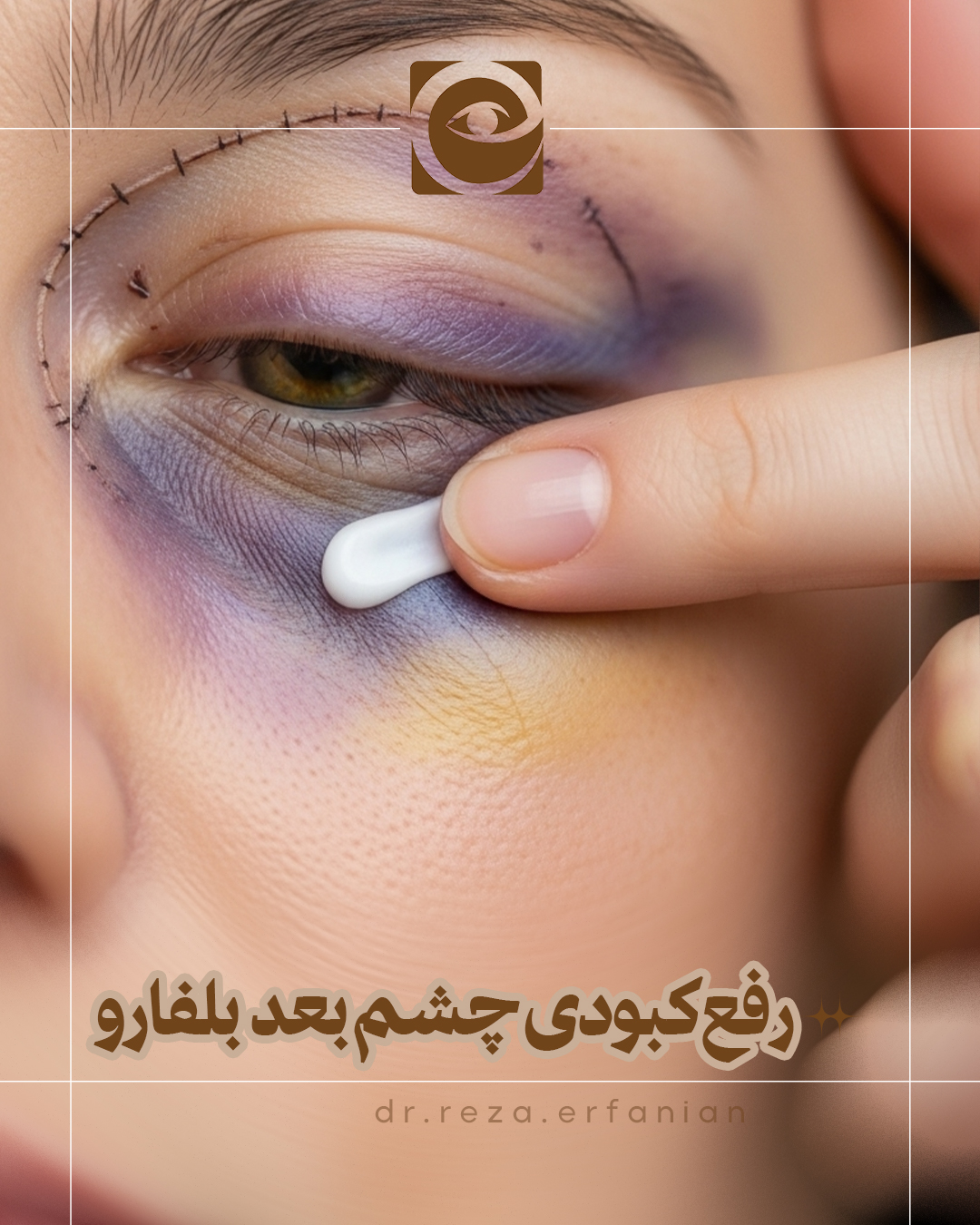 رفع کبودی چشم بعد از عمل بلفاروپلاستی