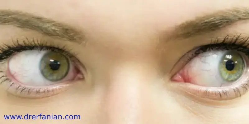 علائم انحراف چشم در بزرگسالان علائم انحراف چشم در بزرگسالان