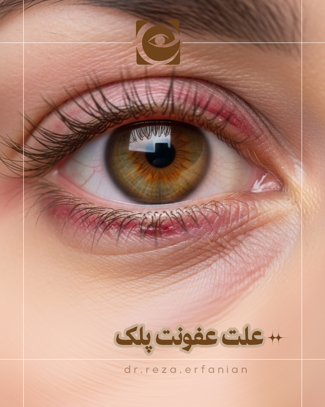 علت عفونت پلک چشم