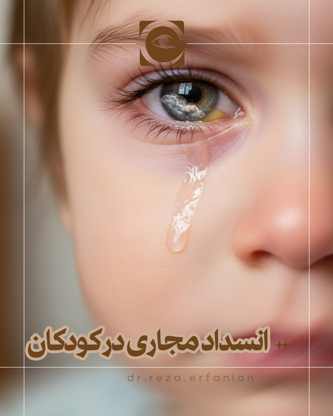 انسداد مجاری اشکی در کودکان