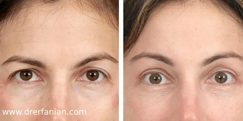 لیفت آندوسکوپی پیشانی لیفت آندوسکوپی پیشانی