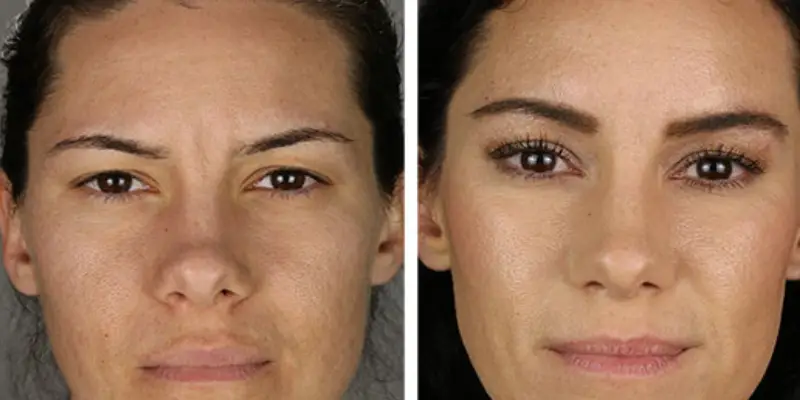 مزیت_های لیفت آندوسکوپی پیشانی مزیتهای لیفت آندوسکوپی پیشانی