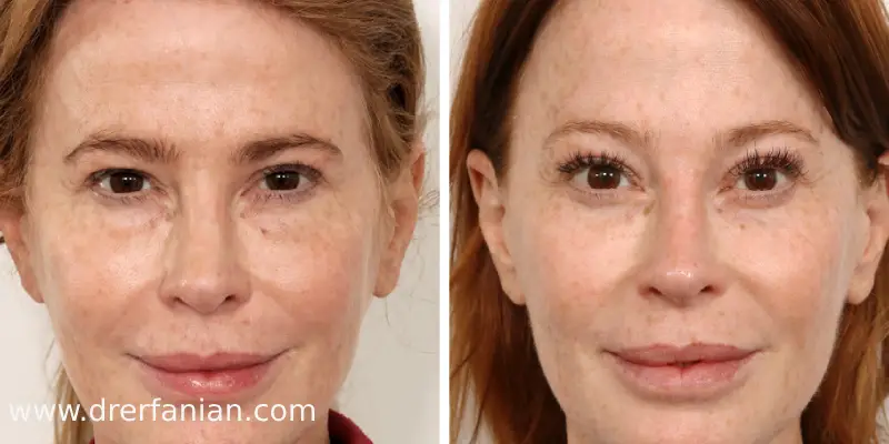 نحوه انجام لیفت آندوسکوپی پیشانی نحوه انجام لیفت آندوسکوپی پیشانی