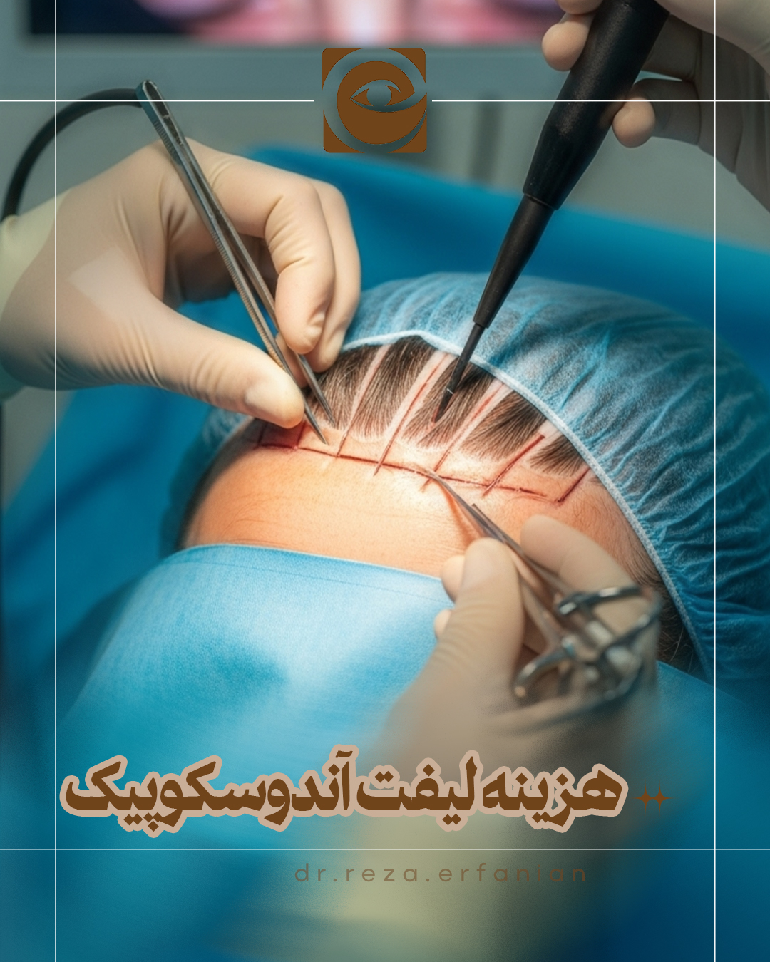 هزینه لیفت آندوسکوپیک پیشانی