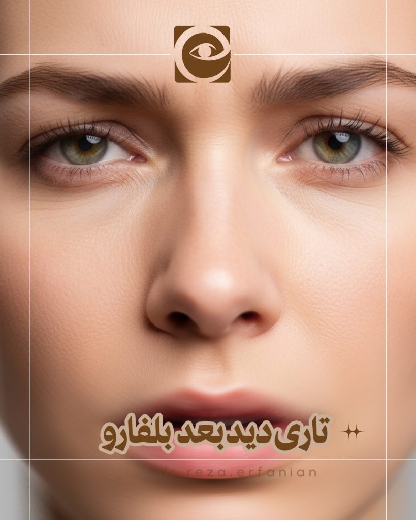 تاری دید بعد از بلفاروپلاستی