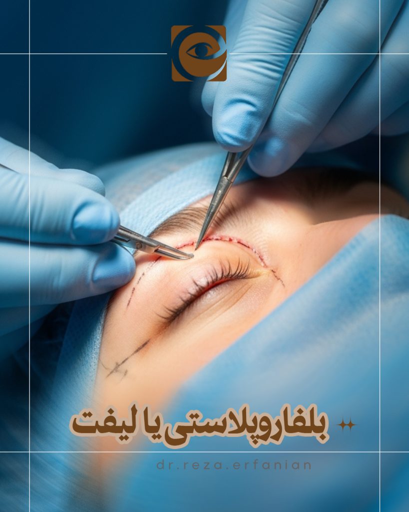 بلفاروپلاستی یا لیفت شقیقه