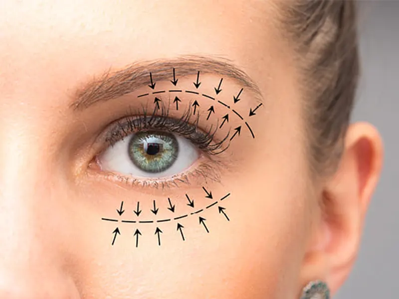 مزیتهای بلفاروپلاستی