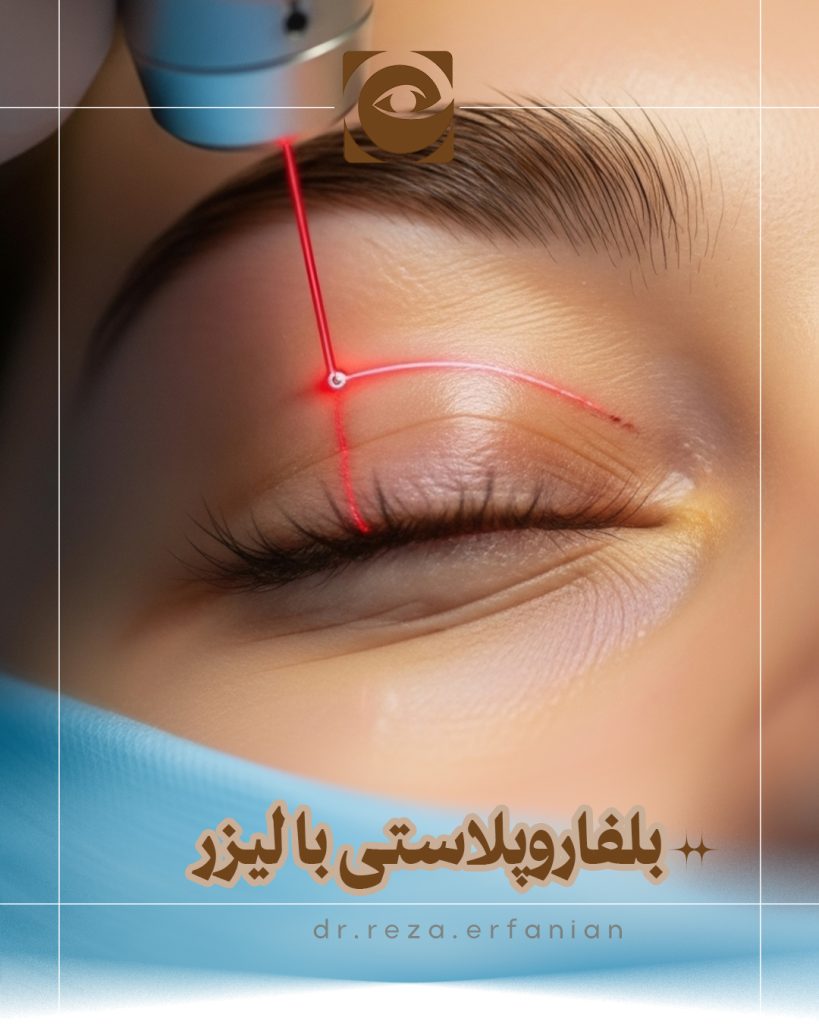 بلفاروپلاستی با لیزر